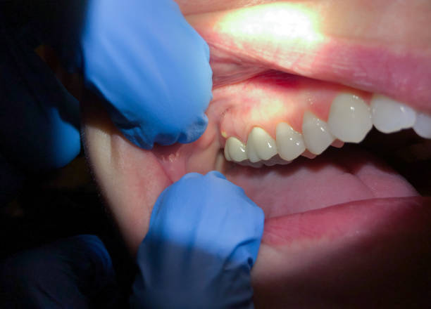 Best Lost Filling or Crown Replacement in Eagan, MN